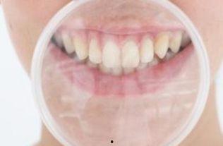 成人全嘴换牙视频播放,跟随视频见证成人换牙全过程